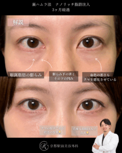 色クマも治す裏ハムラとナノリッチ脂肪注入の症例。京都駅前美容外科の症例画像。