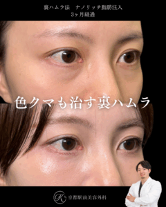 色クマも治す裏ハムラとナノリッチ脂肪注入の症例。京都駅前美容外科の症例画像。