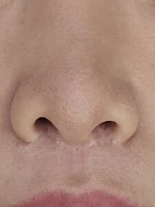 人中短縮と小鼻縮小によりできた傷跡の写真(京都駅前美容外科の医療コラム写真)