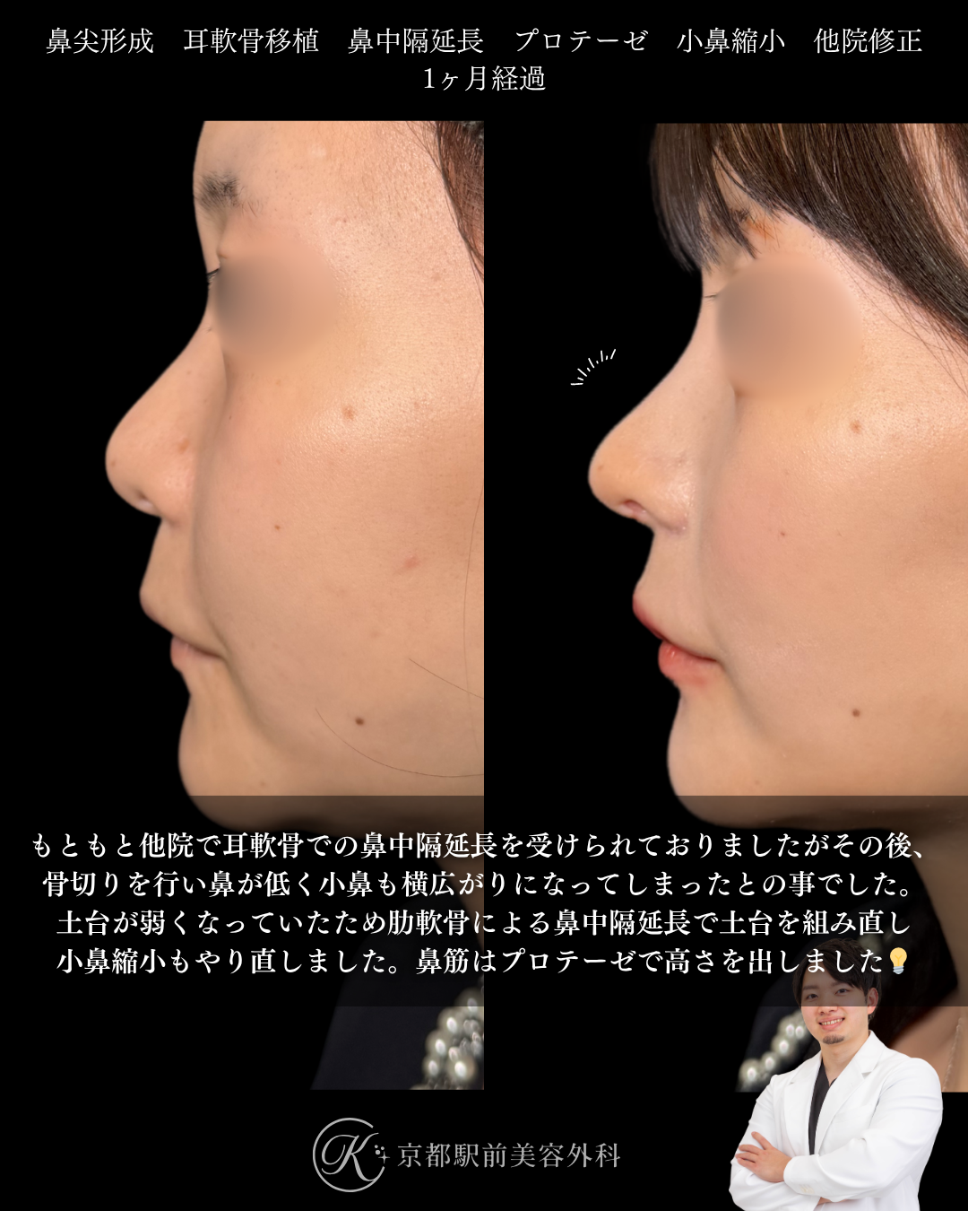 骨切りと他院鼻中隔延長術後の低くなった鼻を美しく戻す。鼻尖形成、耳軟骨移植、鼻中隔延長、プロテーゼ、小鼻縮小、他院修正など（京都駅前美容外科の症例）