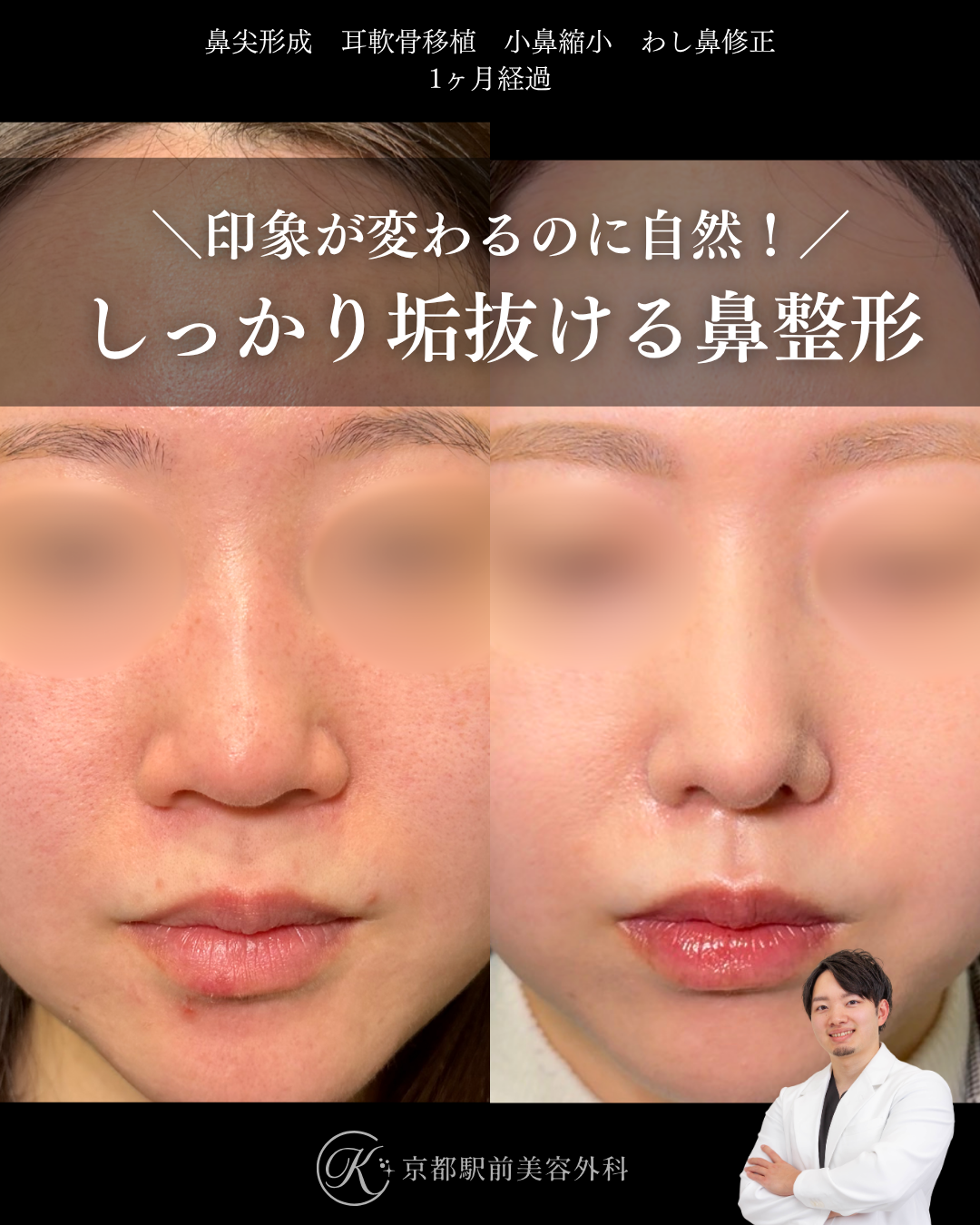 鼻先フル整形で印象が変わるのに自然に垢抜け。鼻尖形成・耳軟骨移植・小鼻縮小・わし鼻修正の１ヶ月経過写真（京都駅前美容外科の鼻整形症例）