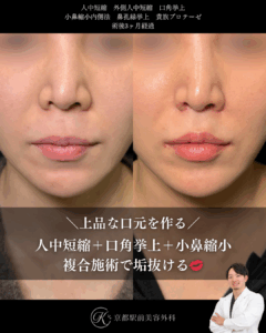 上品な口元を作る。人中短縮、外側人中短縮＋口角挙上、小鼻縮小、鼻孔縁挙上、貴族プロテーゼの術後経過。京都駅前美容外科の症例画像