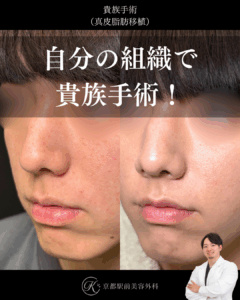 真皮脂肪移植で貴族手術。(京都駅前美容外科の症例写真)