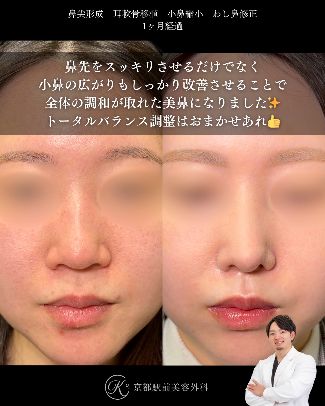 鼻先フル整形で印象が変わるのに自然に垢抜け。鼻尖形成・耳軟骨移植・小鼻縮小・わし鼻修正の１ヶ月経過写真（京都駅前美容外科の鼻整形症例）