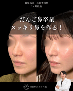 だんご鼻卒業、スッキリした鼻を作る鼻整形。鼻尖形成・耳軟骨移植の１ヶ月経過写真（京都駅前美容外科の鼻整形症例）