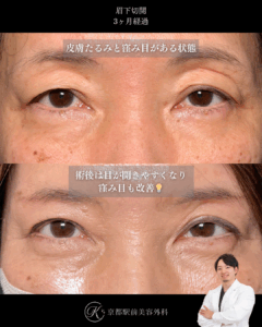 眉下リフトの術後３ヶ月経過。京都駅前美容外科の症例画像。
