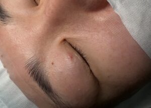 二重埋没手術後（３ヶ月経過時点）に生じた結節・肉芽種（京都駅前美容外科の写真）