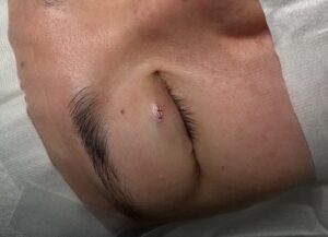 二重埋没手術後（３ヶ月経過時点）に生じた結節・肉芽種除去の術直後（京都駅前美容外科の写真）