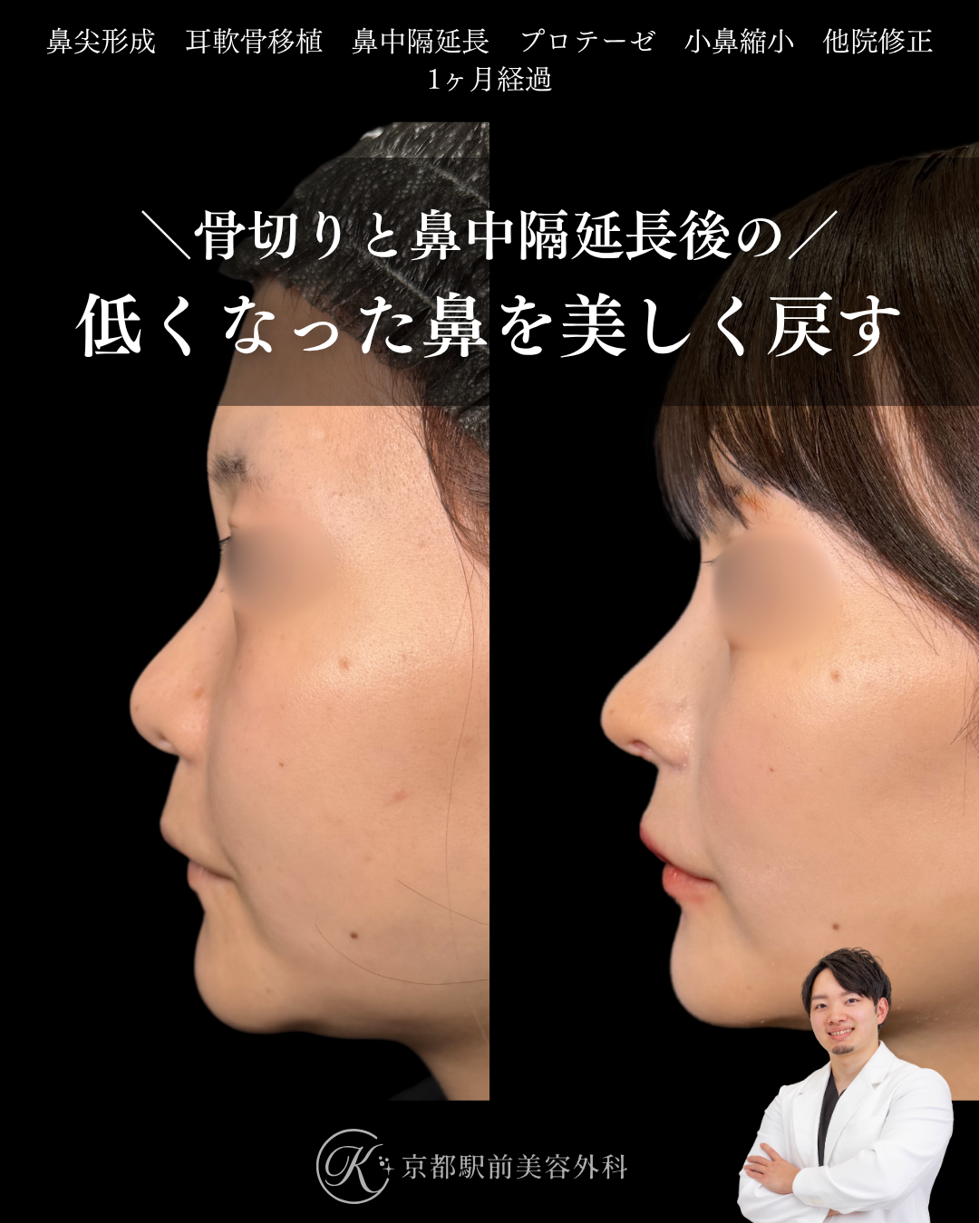 骨切りと他院鼻中隔延長術後の低くなった鼻を美しく戻す。鼻尖形成、耳軟骨移植、鼻中隔延長、プロテーゼ、小鼻縮小、他院修正など（京都駅前美容外科の症例）