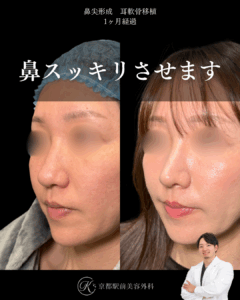 鼻先整形で鼻をスッキリ。鼻尖形成・耳軟骨移植の１ヶ月経過写真（京都駅前美容外科の鼻整形症例）