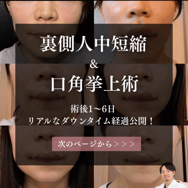裏側人中短縮と口角挙上のダウンタイム経過、術後1日目から6日までの毎日経過。京都駅前美容外科の医療コラム。
