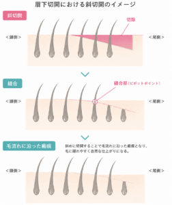 眉下リフトにおける斜切開のイラスト（京都駅前美容外科の医療コラム）