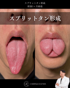 スプリットタン形成の術後１ヶ月経過の症例写真（京都駅前美容外科の症例写真）