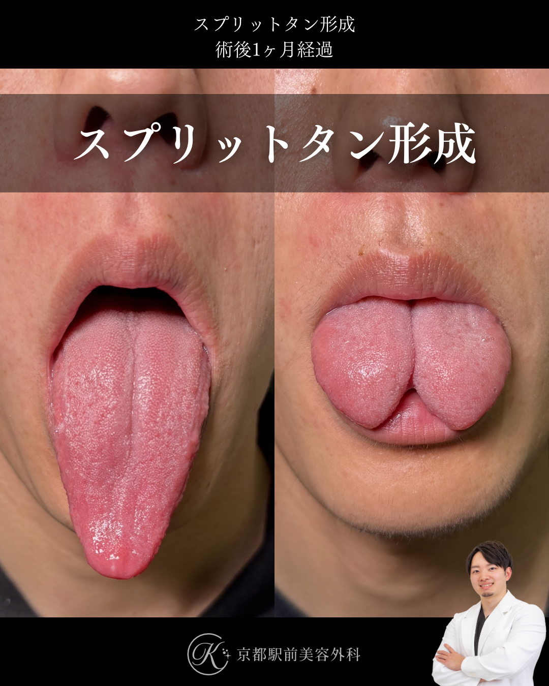 スプリットタン形成の術後１ヶ月経過の症例写真（京都駅前美容外科の症例写真）