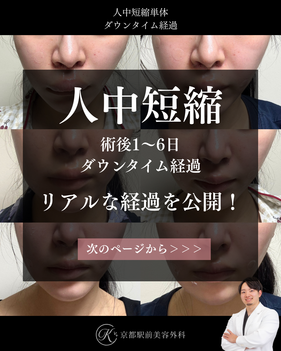 人中短縮のダウンタイム経過、術後1日目から6日までの毎日経過。京都駅前美容外科の医療コラム。