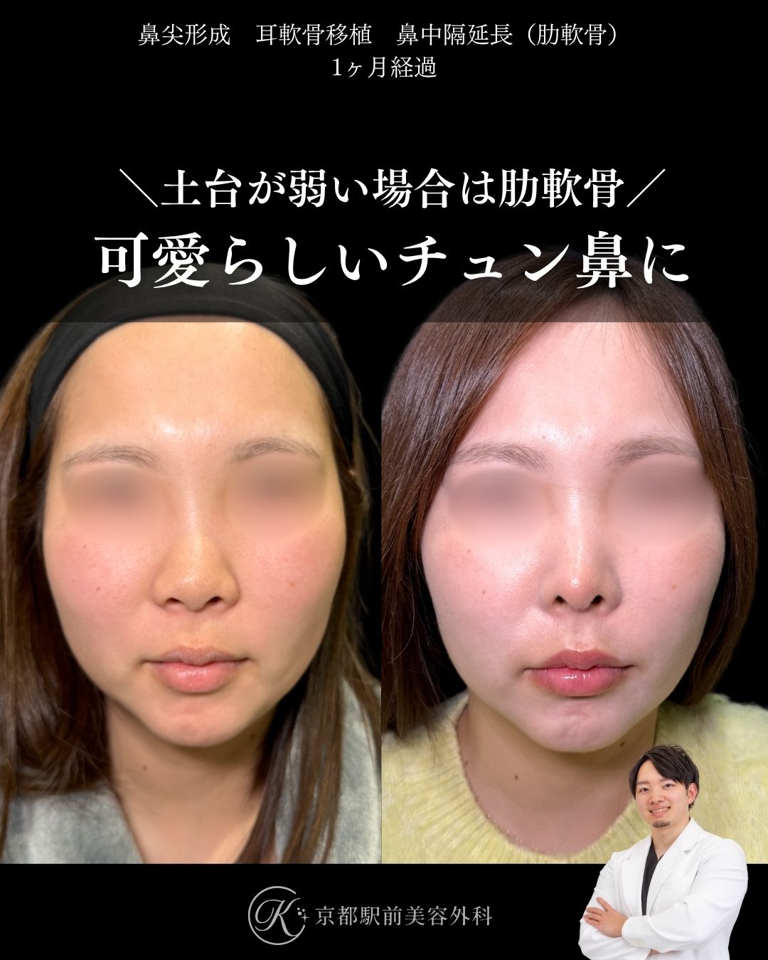 肋軟骨による鼻整形の症例写真（京都駅前美容外科の鼻整形症例）当院は滋賀、京都、大阪をはじめとした関西圏や全国から患者様にお越しいただいています。
