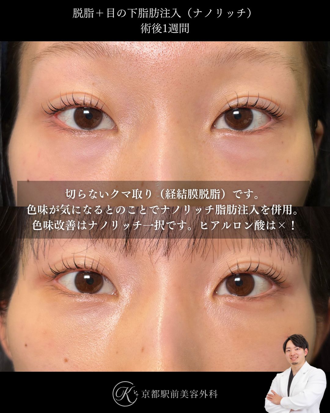 色クマも治す経結膜脱脂術とナノリッチ脂肪注入の症例。京都駅前美容外科の症例画像。当院は滋賀、京都、大阪をはじめとした関西圏や全国から患者様にお越しいただいています。