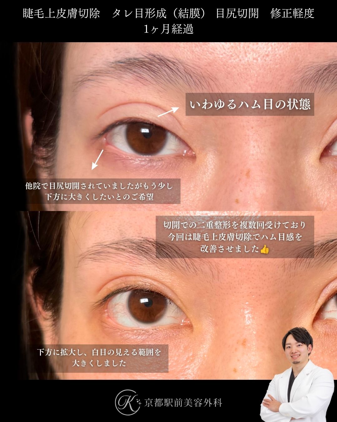 睫毛上皮膚切除でハム目解消、タレ目形成（グラマラスライン形成）と目尻切開でデカ目に。京都駅前美容外科の症例画像。当院は滋賀、京都、大阪をはじめとした関西圏や全国から患者様にお越しいただいています。