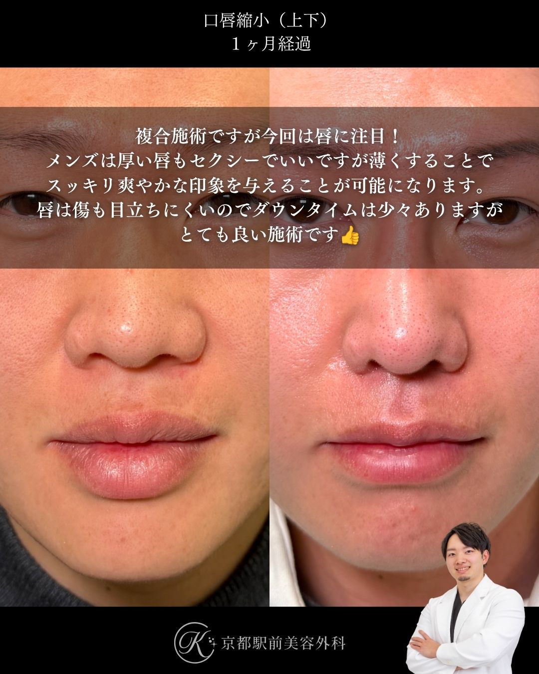 口唇縮小の術後経過写真（京都駅前美容外科の症例）当院は滋賀、京都、大阪をはじめとした関西圏や全国から患者様にお越しいただいています。