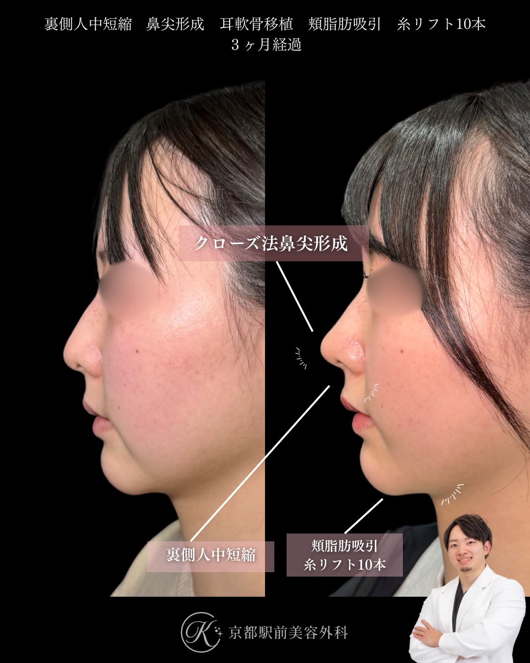 頬脂肪吸引、糸リフト、クローズ法の鼻尖形成、耳軟骨移植、裏側人中短縮の症例（京都駅前美容外科の症例写真）当院は滋賀、京都、大阪をはじめとした関西圏や全国から患者様にお越しいただいています。
