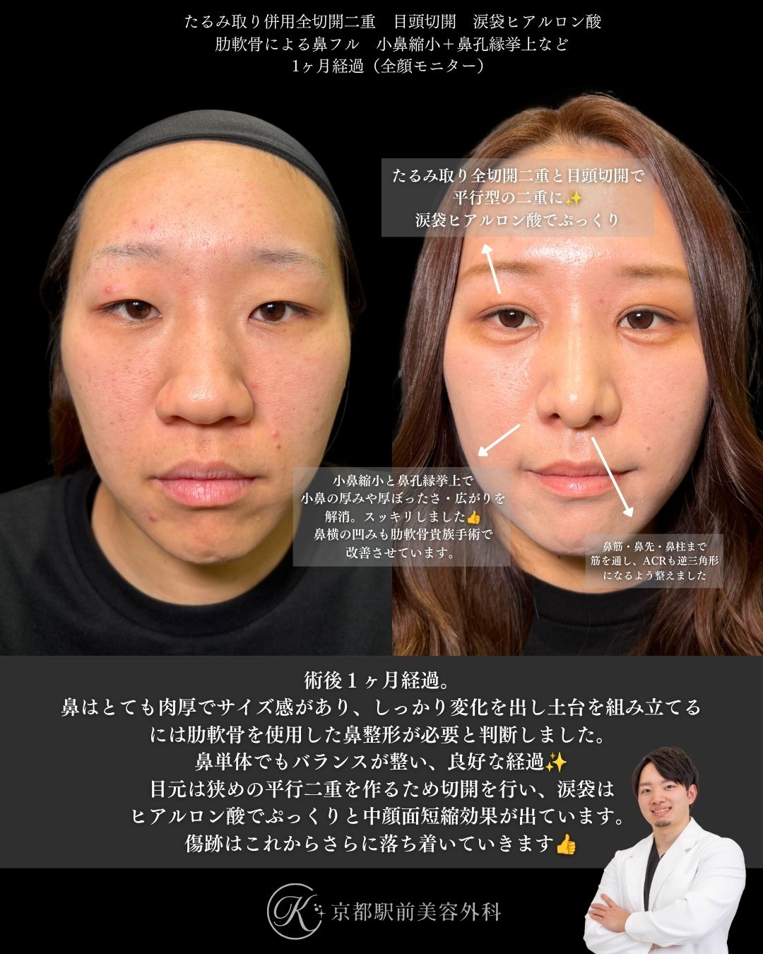 肋軟骨による鼻整形と目元整形（たるみ取り併用全切開と目頭切開と涙袋ヒアルロン酸）の術直後写真（京都駅前美容外科の鼻整形症例）当院は滋賀、京都、大阪をはじめとした関西圏や全国から患者様にお越しいただいています。
