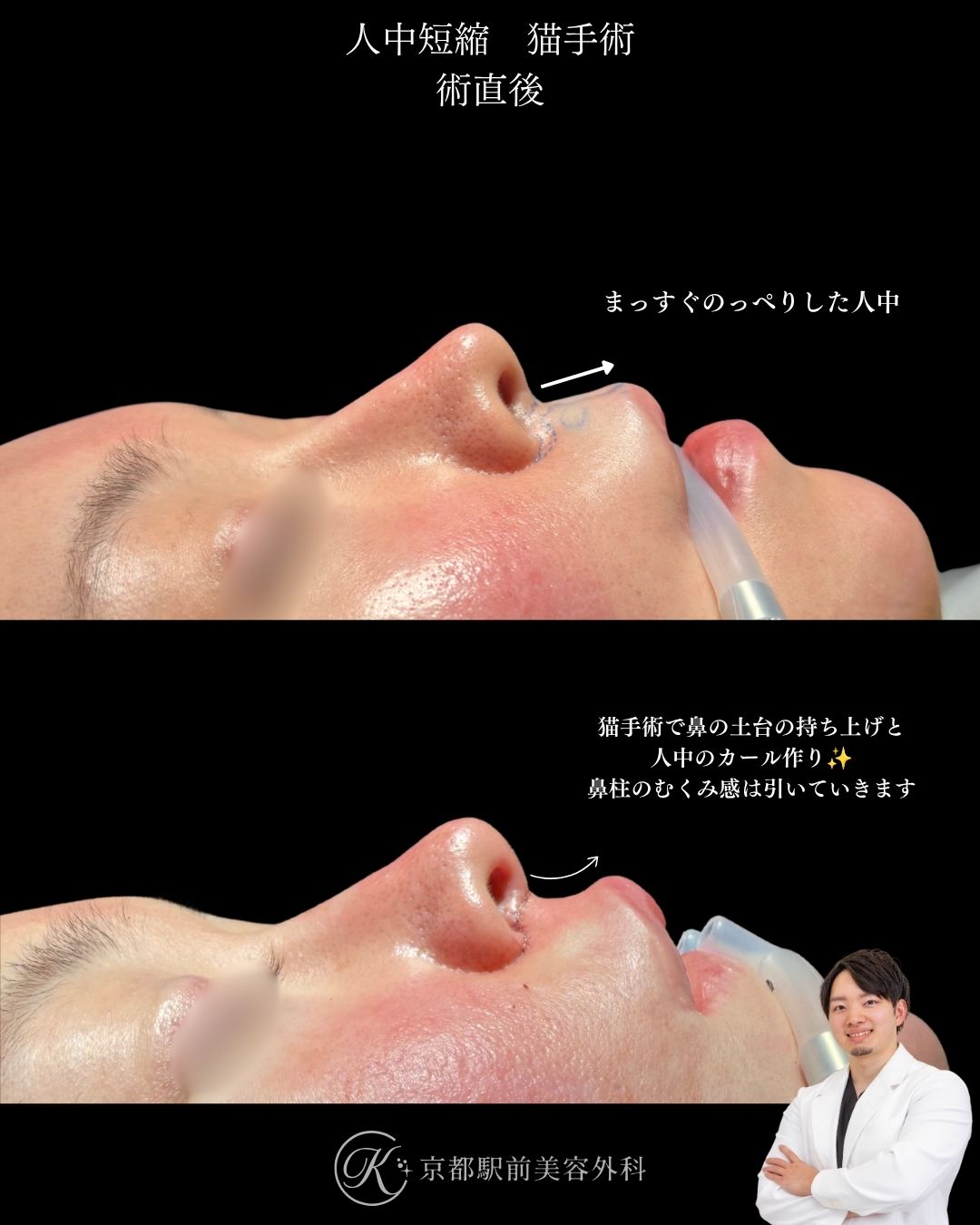 人中短縮と猫手術（鼻唇角形成）の術直後写真です。鼻柱部分が持ち上がり人中はカールを形成することで可愛らしい横顔に変化しました。京都駅前美容外科では一歩先を行く人中短縮術を提供しています。当院は滋賀、京都、大阪をはじめとした全国から患者様にお越しいただいています。