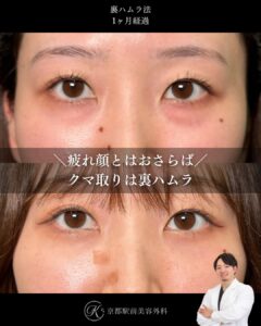 裏ハムラ法(クマ取り)の1ヶ月後経過の写真です(京都駅前美容外科の症例)。目の下の膨らみとその下の凹み・溝を改善させます。目の表の皮膚を切らないため傷跡は直後からわかりません。クマを治すことで、若々しいお目元へと変化させることができます。当院は滋賀、京都、大阪をはじめとした全国から患者様にお越しいただいています。