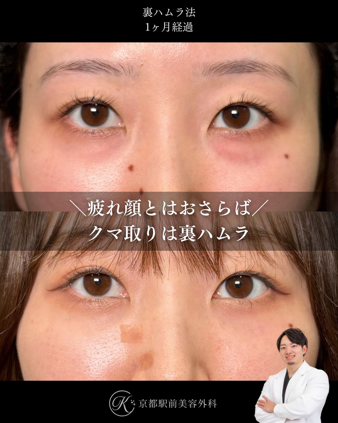 裏ハムラ法（クマ取り）の１ヶ月後経過の写真です（京都駅前美容外科の症例）。目の下の膨らみとその下の凹み・溝を改善させます。目の表の皮膚を切らないため傷跡は直後からわかりません。クマを治すことで、若々しいお目元へと変化させることができます。当院は滋賀、京都、大阪をはじめとした全国から患者様にお越しいただいています。