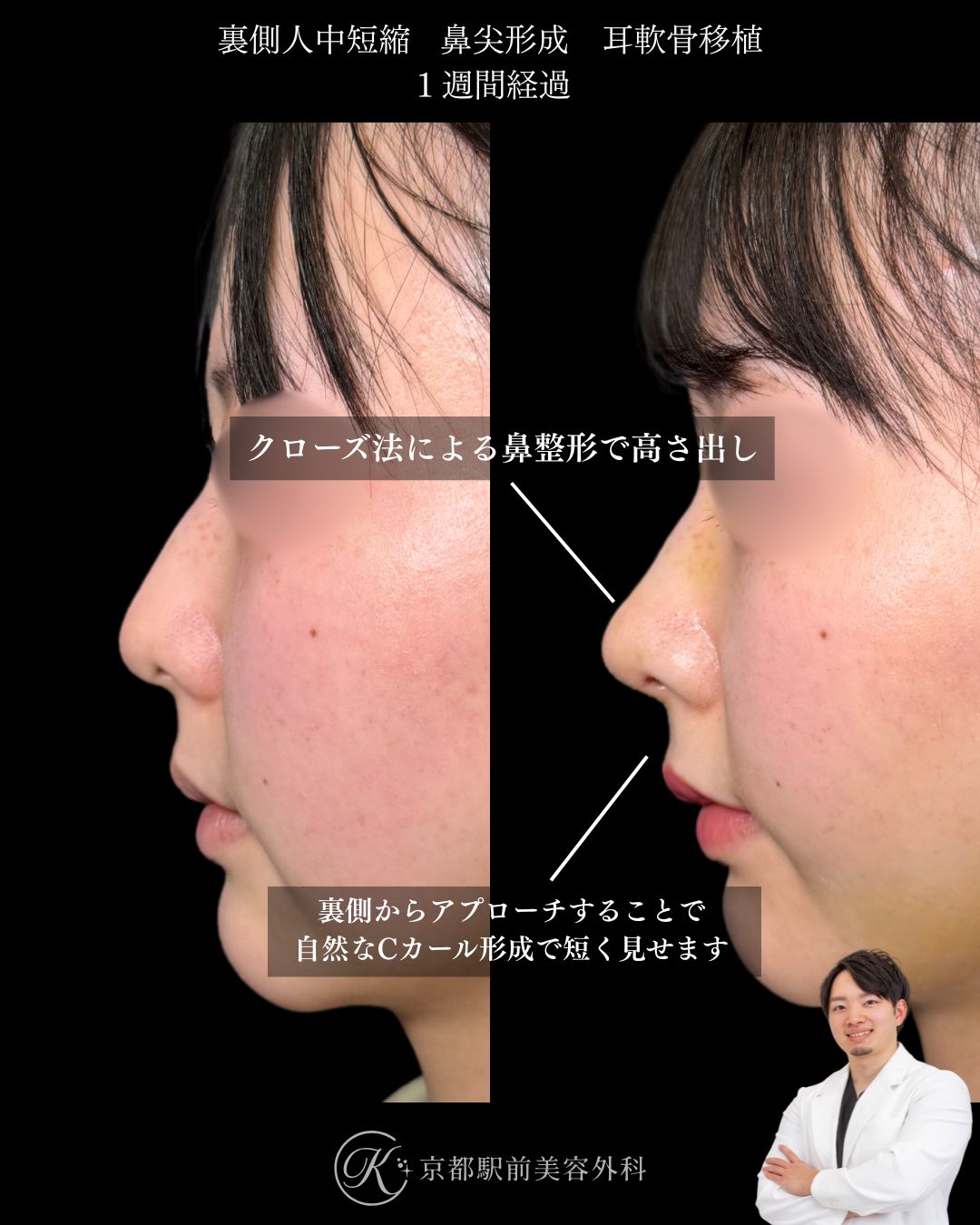 クローズ法の鼻尖形成、耳軟骨移植、裏側人中短縮の症例（京都駅前美容外科の症例写真）当院は滋賀、京都、大阪をはじめとした関西圏や全国から患者様にお越しいただいています。