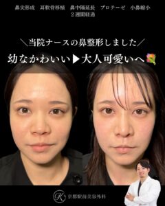 肋軟骨による鼻整形、小鼻縮小、プロテーゼの症例写真(京都駅前美容外科の鼻整形症例)当院は滋賀、京都、大阪をはじめとした関西圏や全国から患者様にお越しいただいています。