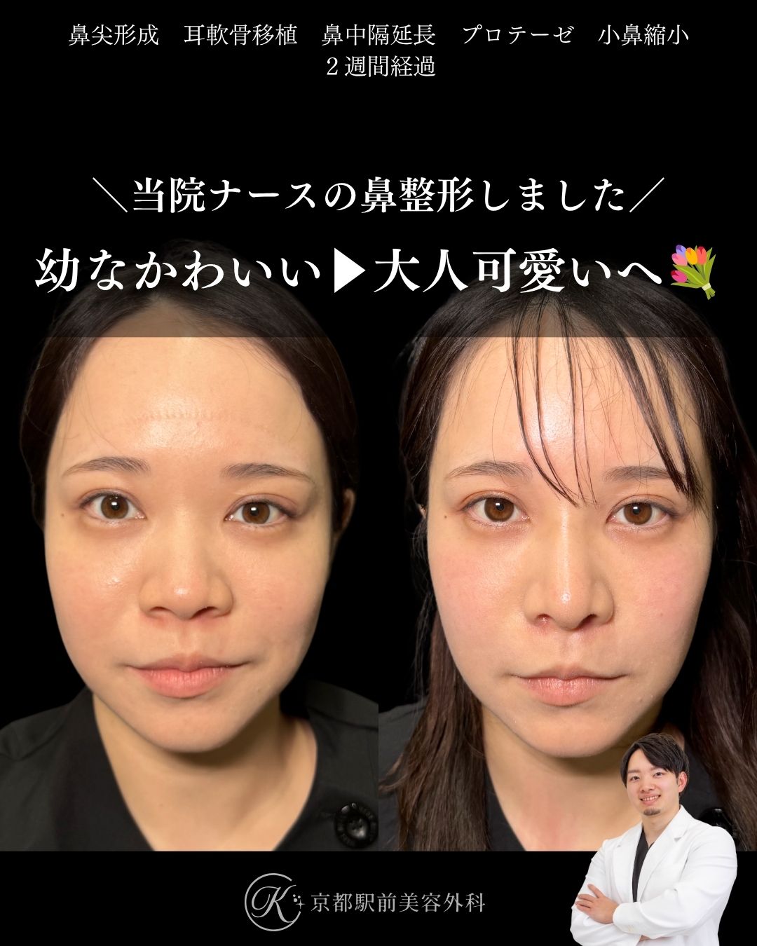 肋軟骨による鼻整形、小鼻縮小、プロテーゼの症例写真（京都駅前美容外科の鼻整形症例）当院は滋賀、京都、大阪をはじめとした関西圏や全国から患者様にお越しいただいています。