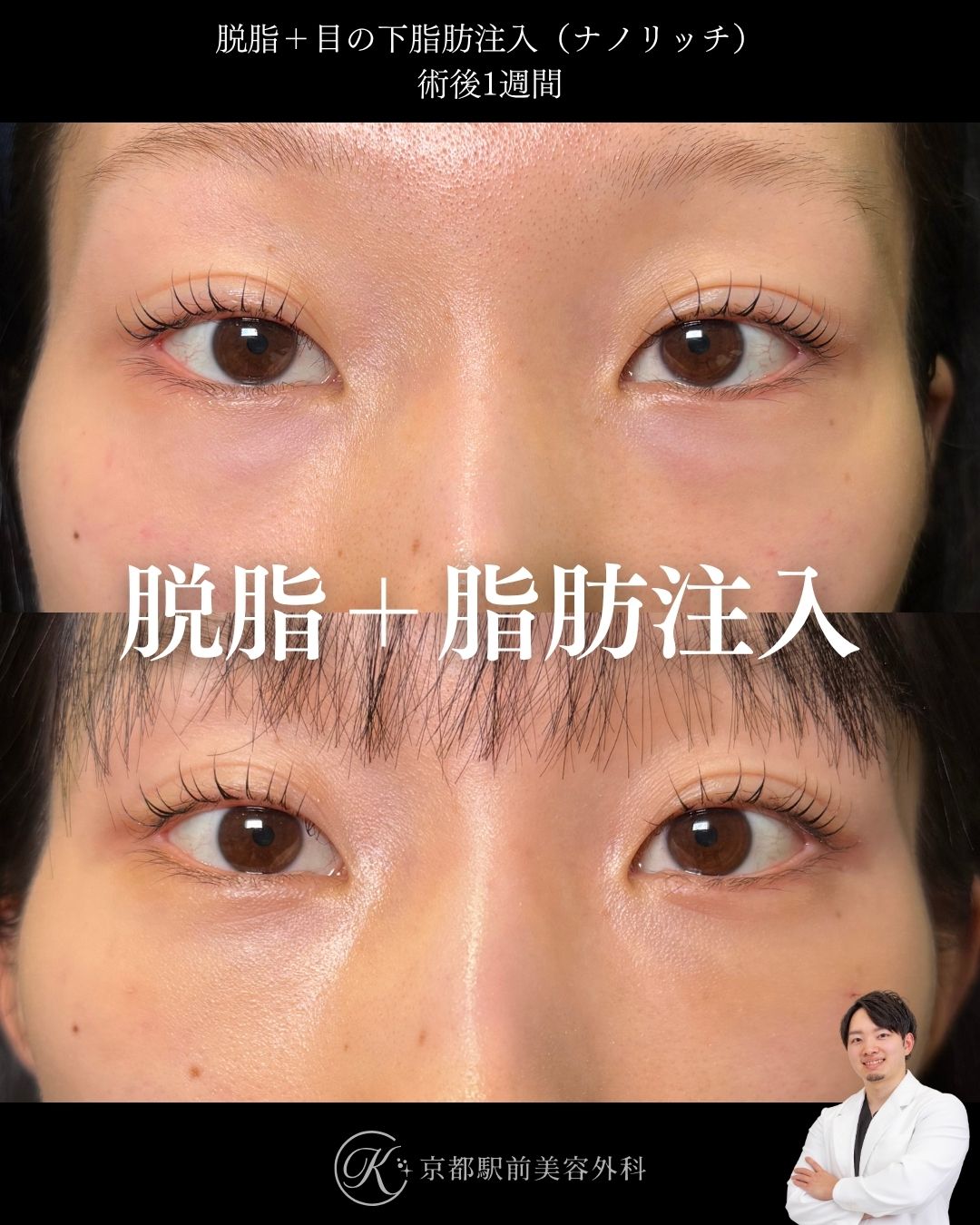 色クマも治す経結膜脱脂術とナノリッチ脂肪注入の症例。京都駅前美容外科の症例画像。当院は滋賀、京都、大阪をはじめとした関西圏や全国から患者様にお越しいただいています。