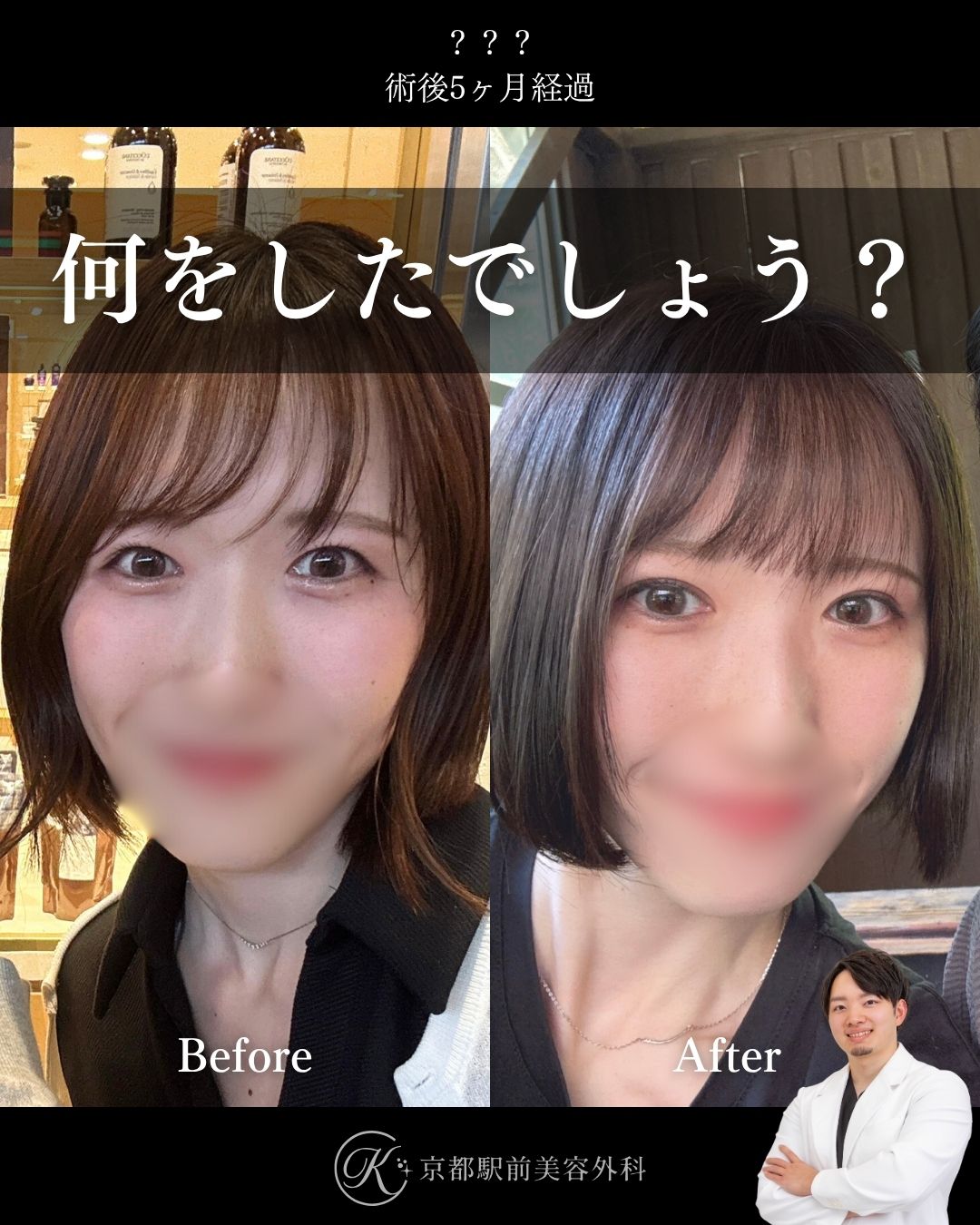 たるみ取り併用全切開二重術の症例写真（京都駅前美容外科の症例）。二重切開で一生物の二重を叶えます。たるみも取ることでまつげの生え際が見え、垢抜けた印象を与えます。二重整形の名医なら京都駅前美容外科にお任せ。二重整形の似合わせデザインもお任せください。