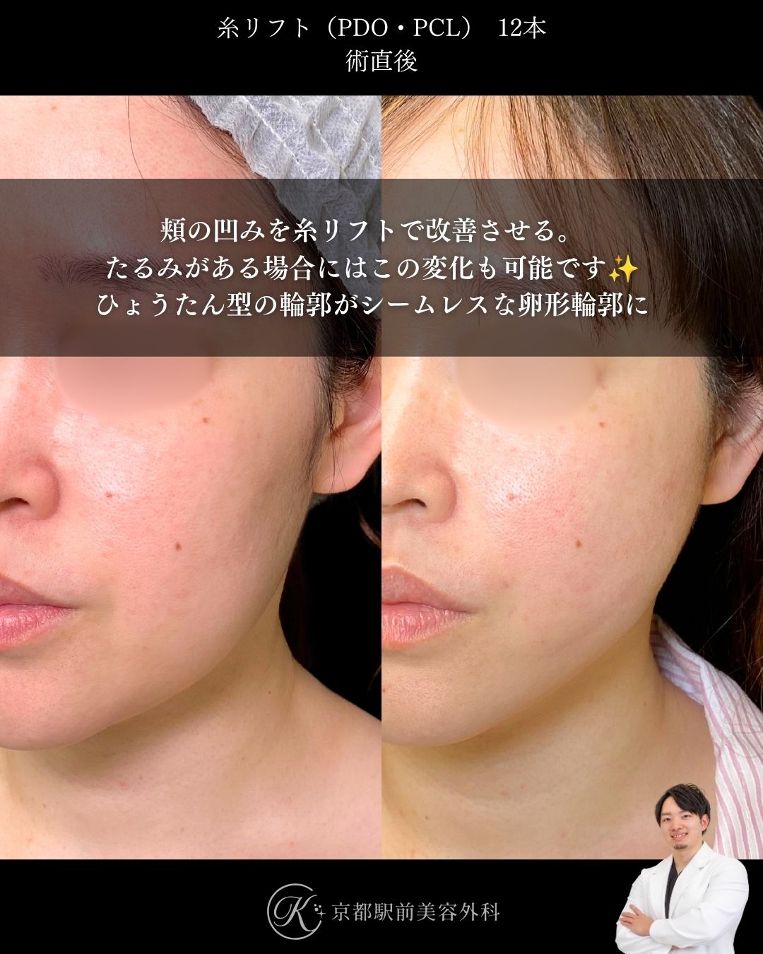 肌にハリを戻す！たるみを改善する糸リフト。京都駅前美容外科の症例画像。当院は滋賀、京都、大阪をはじめとした関西圏や全国から患者様にお越しいただいています。