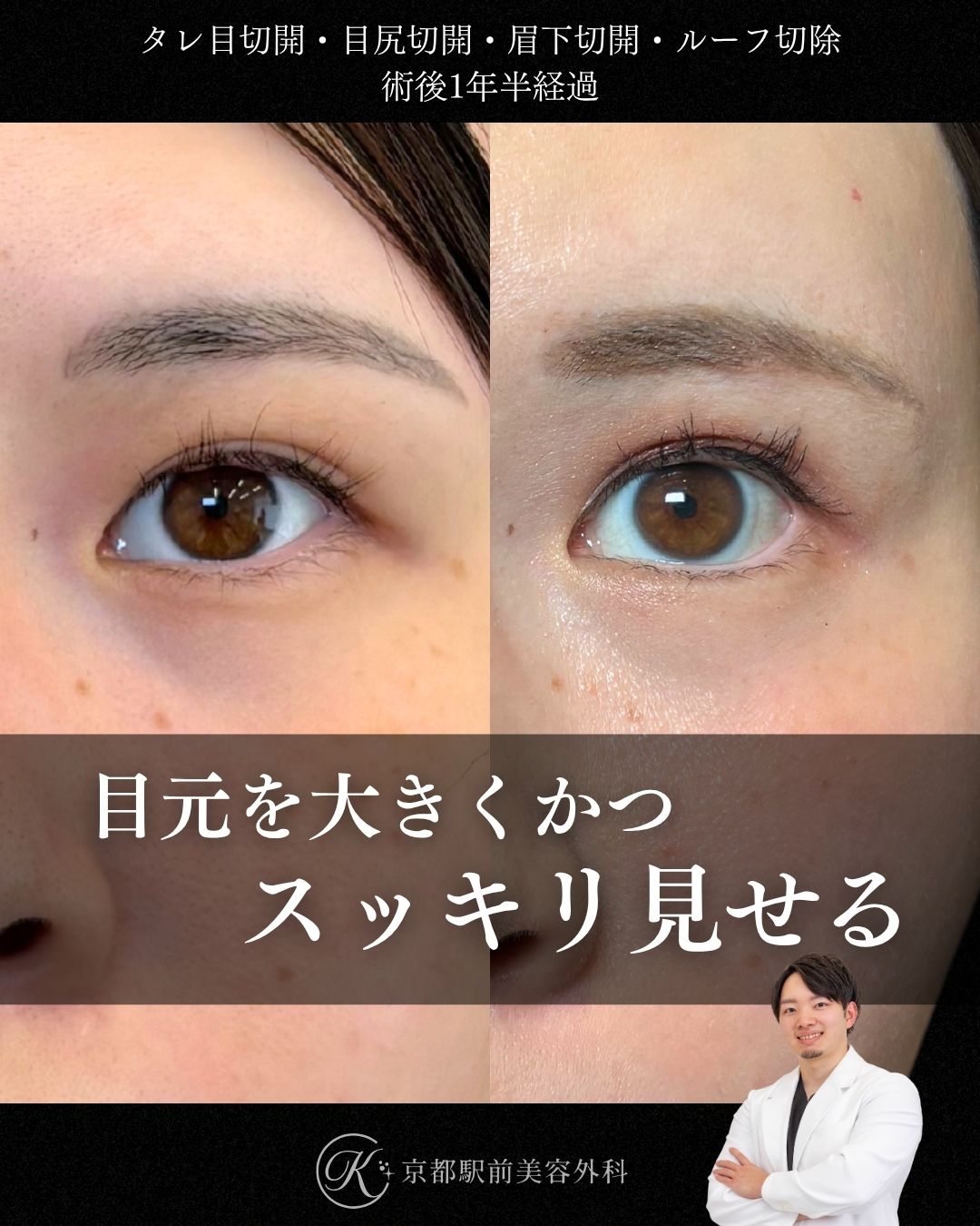 タレ目形成（グラマラスライン形成）（皮膚結膜）、目尻切開、目頭切開、眉下切開、roof切除の術後経過。京都駅前美容外科の症例画像。当院は滋賀、京都、大阪をはじめとした関西圏や全国から患者様にお越しいただいています。