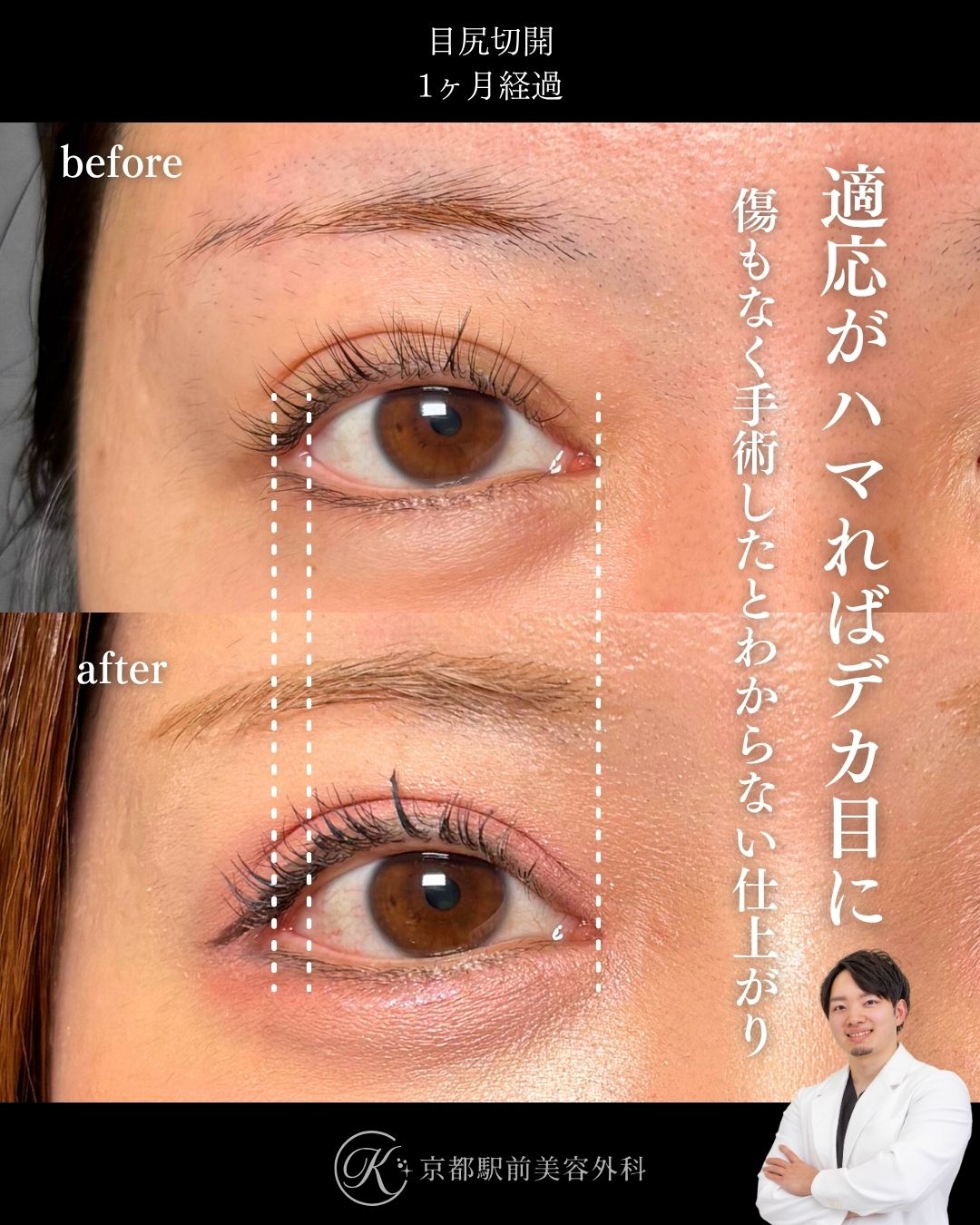 目尻切開の術直後写真（京都駅前美容外科の症例）当院は滋賀、京都、大阪をはじめとした関西圏や全国から患者様にお越しいただいています。