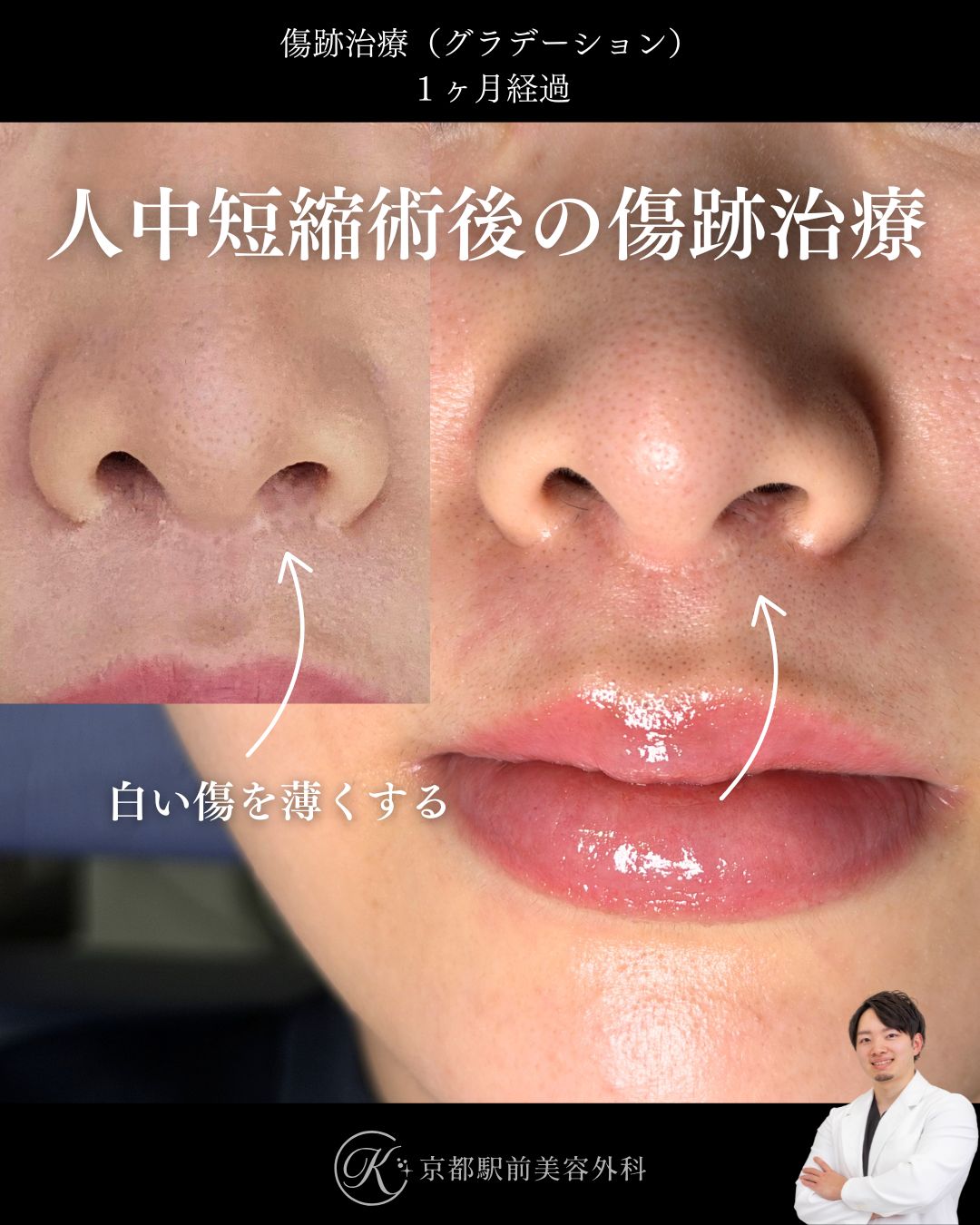 切らずに治す傷跡治療・傷跡修正（グラデーション治療）の症例画像。人中短縮と小鼻縮小によりできた傷跡の写真など（京都駅前美容外科の症例写真）当院は滋賀、京都、大阪をはじめとした関西圏や全国から患者様にお越しいただいています。
