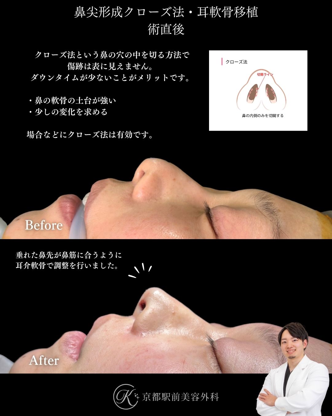 鼻尖形成クローズ法と耳軟骨移植の術直後です。腫れにくい、バレにくい、鼻整形の方法の1つです。鼻筋から鼻先にかけてストレートなラインができるように調整し、鼻先の丸みも改善しています。関西、大阪、京都、滋賀で鼻整形は京都駅前美容外科にお任せを。