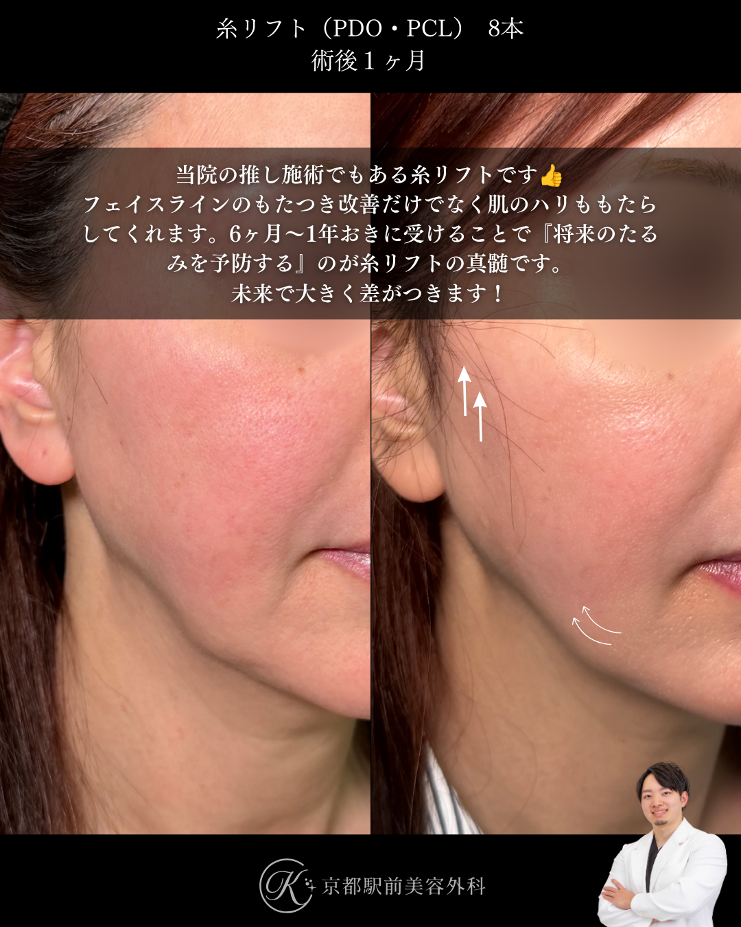 肌にハリを戻す！たるみを改善する糸リフト。京都駅前美容外科の症例画像。当院は滋賀、京都、大阪をはじめとした関西圏や全国から患者様にお越しいただいています。