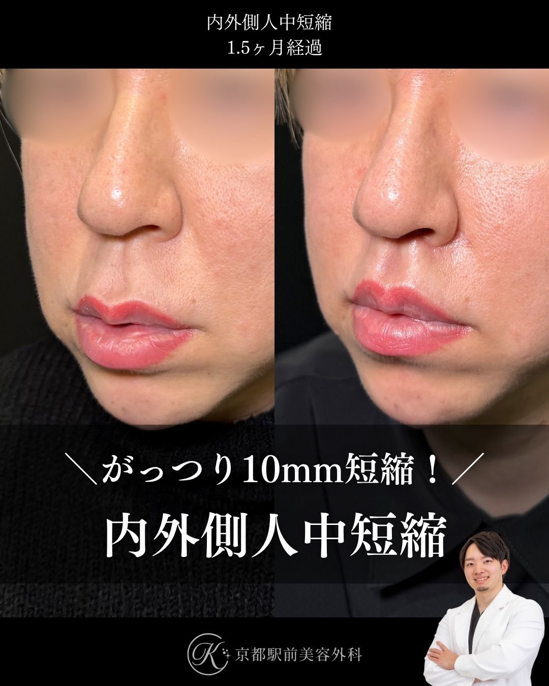 内外側人中短縮（拡大人中短縮）の症例写真（京都駅前美容外科の症例）当院は滋賀、京都、大阪をはじめとした関西圏や全国から患者様にお越しいただいています。