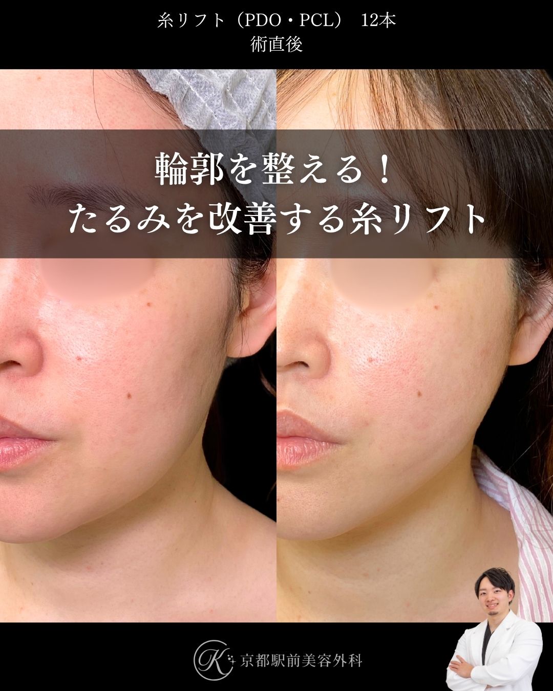 肌にハリを戻す！たるみを改善する糸リフト。京都駅前美容外科の症例画像。当院は滋賀、京都、大阪をはじめとした関西圏や全国から患者様にお越しいただいています。