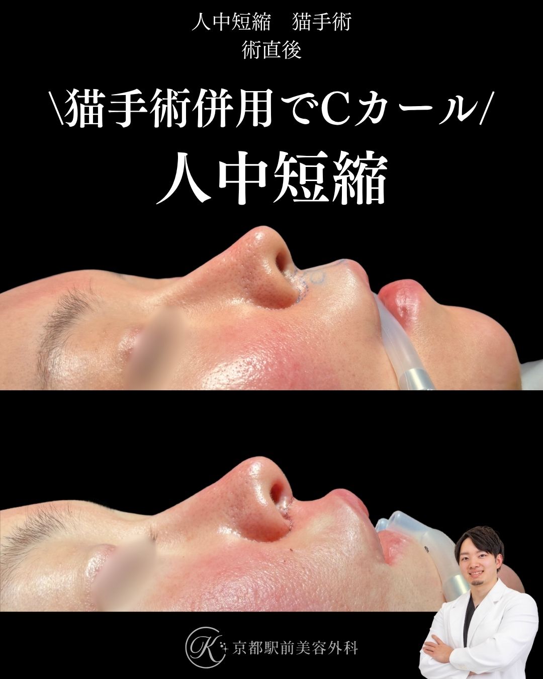 人中短縮と猫手術（鼻唇角形成）の術直後写真です。鼻柱部分が持ち上がり人中はカールを形成することで可愛らしい横顔に変化しました。京都駅前美容外科では一歩先を行く人中短縮術を提供しています。当院は滋賀、京都、大阪をはじめとした全国から患者様にお越しいただいています。