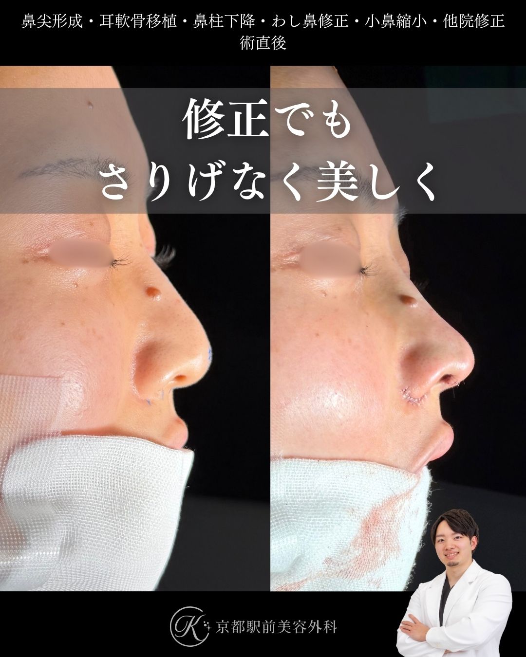 鼻整形の修正（鼻尖形成・耳軟骨移植・小鼻縮小・わし鼻修正・鼻柱下降・他院修正）の術直後写真（京都駅前美容外科の鼻整形症例）当院は滋賀、京都、大阪をはじめとした関西圏や全国から患者様にお越しいただいています。