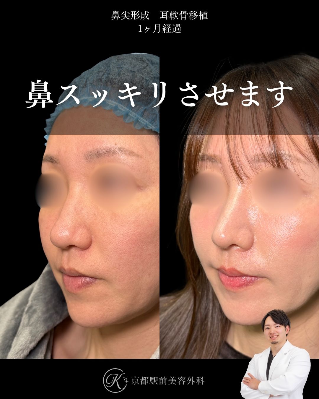 だんご鼻卒業、スッキリした鼻を作る鼻整形。鼻尖形成・耳軟骨移植の１ヶ月経過写真（京都駅前美容外科の鼻整形症例）当院は滋賀、京都、大阪をはじめとした関西圏や全国から患者様にお越しいただいています。