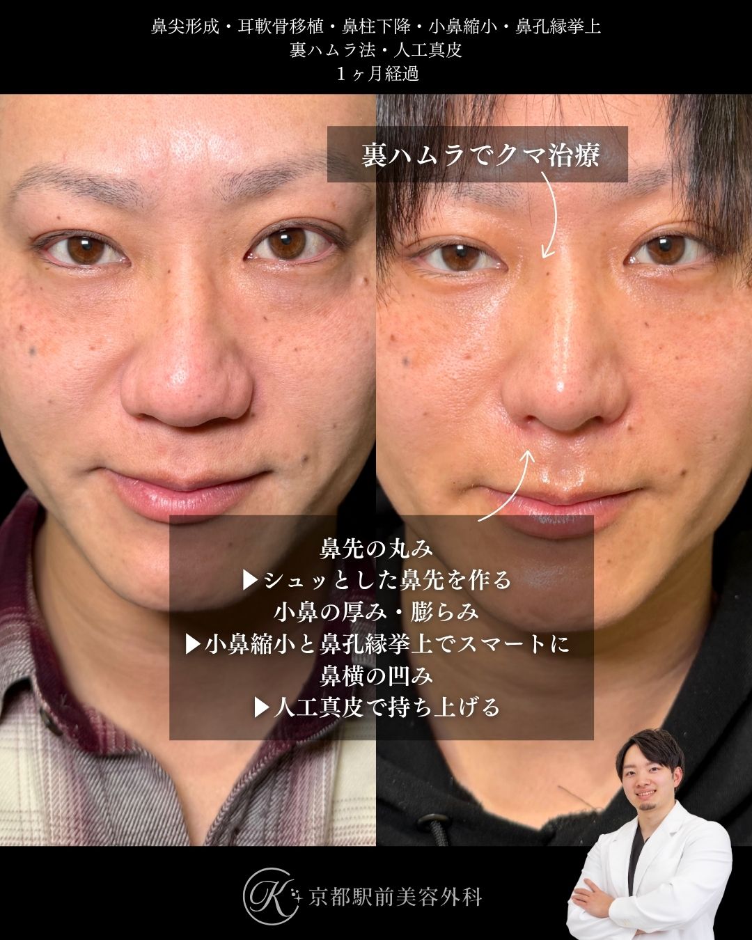 鼻尖形成・耳軟骨移植・小鼻縮小・鼻孔縁挙上・人工真皮・裏ハムラ法の術後経過写真（京都駅前美容外科の症例写真）当院は滋賀、京都、大阪をはじめとした関西圏や全国から患者様にお越しいただいています。