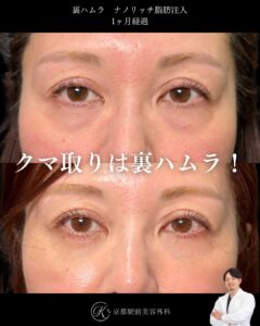 色クマも治す裏ハムラとナノリッチ脂肪注入の症例。京都駅前美容外科の症例画像。当院は滋賀、京都、大阪をはじめとした関西圏や全国から患者様にお越しいただいています。