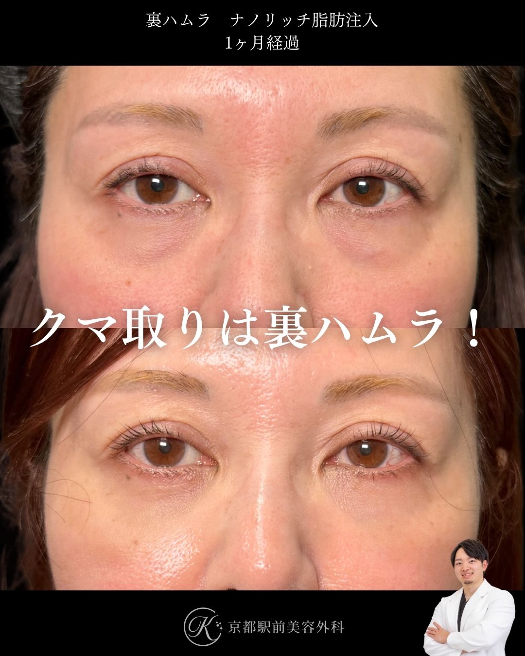 色クマも治す裏ハムラとナノリッチ脂肪注入の症例。京都駅前美容外科の症例画像。当院は滋賀、京都、大阪をはじめとした関西圏や全国から患者様にお越しいただいています。