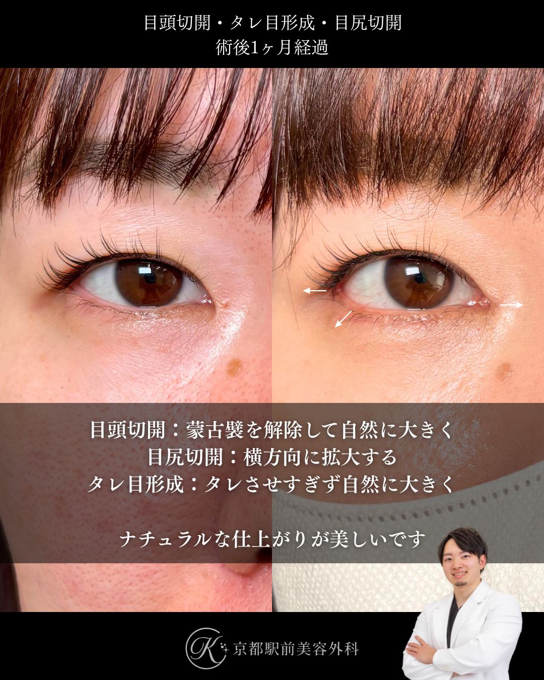 タレ目形成（グラマラスライン形成）（皮膚結膜）、目尻切開、目頭切開の術後経過。京都駅前美容外科の症例画像。当院は滋賀、京都、大阪をはじめとした関西圏や全国から患者様にお越しいただいています。