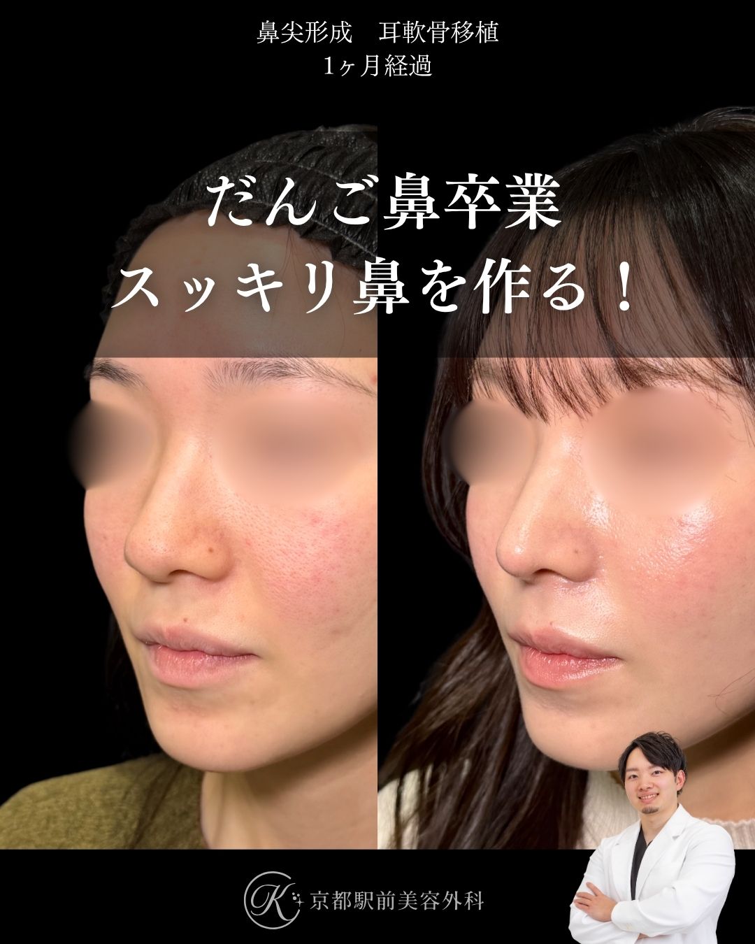 だんご鼻卒業、スッキリした鼻を作る鼻整形。鼻尖形成・耳軟骨移植の１ヶ月経過写真（京都駅前美容外科の鼻整形症例）当院は滋賀、京都、大阪をはじめとした関西圏や全国から患者様にお越しいただいています。