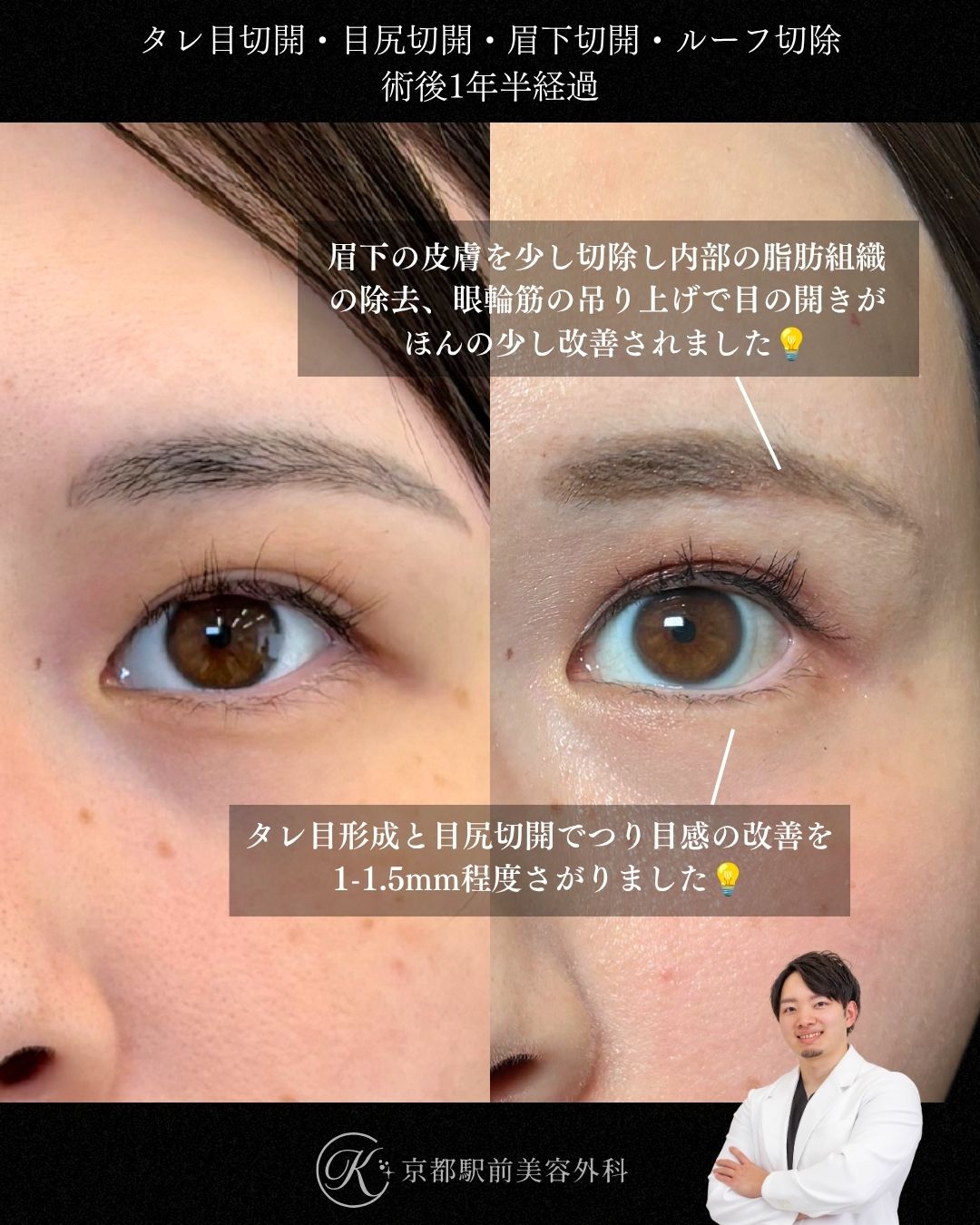 タレ目形成（グラマラスライン形成）（皮膚結膜）、目尻切開、目頭切開、眉下切開、roof切除の術後経過。京都駅前美容外科の症例画像。当院は滋賀、京都、大阪をはじめとした関西圏や全国から患者様にお越しいただいています。